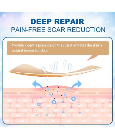 Scar Away Silicone Scar Sheets - 1.6 x 60 Roll - Surgical, C-Section, Keloid, Tummy Tuck, Burn, Stretch Marks - Reusable Scar Removal Strips - Buy Online on GoSupps.com