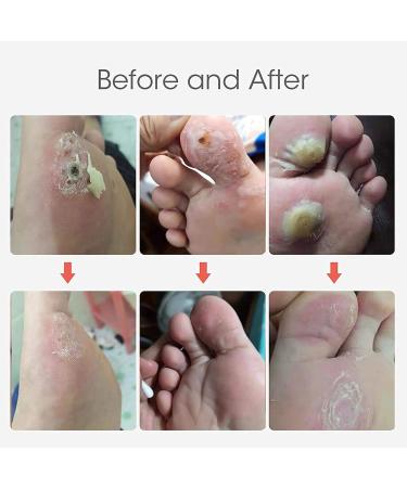 MQ 36 Pcs Corn Removal Pads for Foot Corn, Toe Corn, Callus Removal - Stops Wart Regrowth & Provides Pain Relief - Foot Care (36 Count) - Buy Online on GoSupps.com