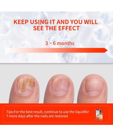 Extra Strength Toenail Fungus Treatment - 30ML Nail Solution with Soft Brush - Transform Your Nails & Boost Confidence - Buy Online on GoSupps.com