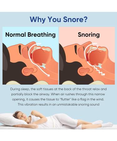 Memonotry Snoring Aid Mouthpiece - Shapeable Anti-Snoring Device for Men/Women - Stop Snoring Comfortably - 1PCS - Buy Online on GoSupps.com
