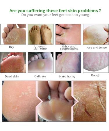 Urea Foot Cream - Urea 42% Foot Cream - Foot Cream for Cracked Heels and Dry Skin - Cracked Heel Repair Cream - Foot Moisturiser Callus Remover Nourishes Soften for Feet Knees Hand - Buy Online on GoSupps.com