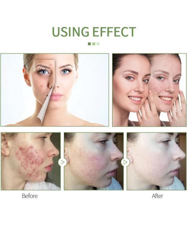 Tea Tree Acne Cream Tea Tree Acne Face Cream Pimple Cream Tea Tree Cream Acne Cream For Face Tea Tree Face Ance Gel Spot Cream for Acne Reduce Redness & Dryness Oil Control Smooth Skin - Buy Online on GoSupps.com