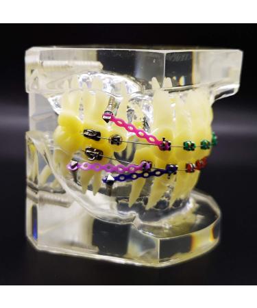 Dental Typodont Orthodontic Teeth Model with Metal Braces & Ligature Ties - Buy Online on GoSupps.com