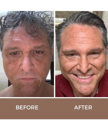 Fake Bake Vitiligo Vanquish Camouflage Kit - Long Lasting Concealer for Skin Depigmentation - Natural Color Customization for Women & Men - Buy Online on GoSupps.com