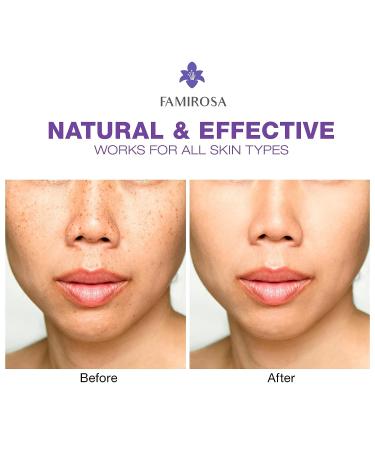 Dark Spot Remover for Face and Body - Melasma & Freckle Corrector - Hyperpigmentation Treatment - Buy Online on GoSupps.com