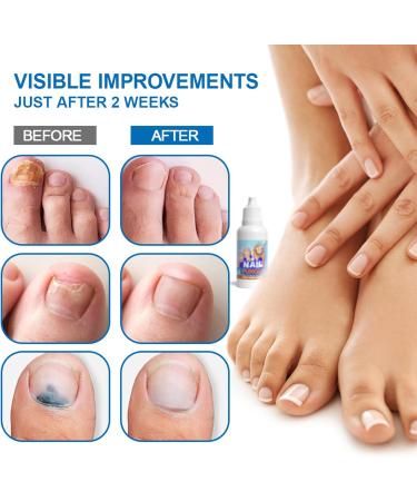 Fungal Nail Treatment - Fungal Nail Treatment for Toenails Extra Strong - Anti Fungus Nail Repair and Strengthen - Toenail Fungus Treatment for Thickening Yellow-Brown Discoloration Ragginess 20ML - Buy Online on GoSupps.com