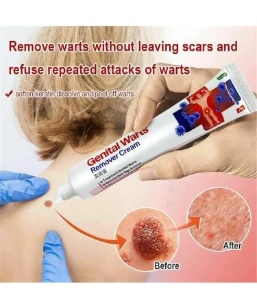 2023 New Herpes & Wart Ointment - Genital & Vulva Treatment for Condyloma Acuminatum (20g) - Fast International Shipping - Buy Online on GoSupps.com