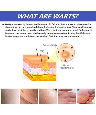 Fast-Acting Liquid Wart Remover for Plantar Wart Treatment - Removes Corns and Smoothes Skin - All Skin Types - Buy Online on GoSupps.com