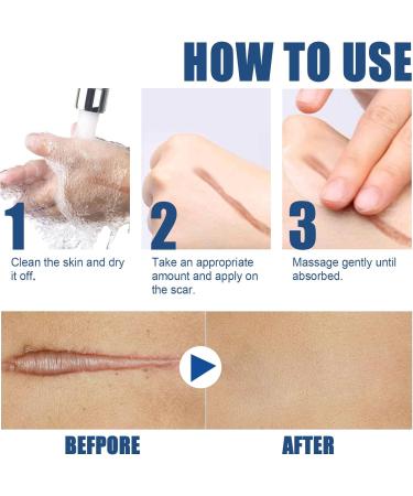 Advanced Scar Removal Cream - Silicone Gel for Old & New Scars, Acne, C-Section, Burns & Stretch Marks - Moisturizing Skin Repair - 2PCS - Buy Online on GoSupps.com