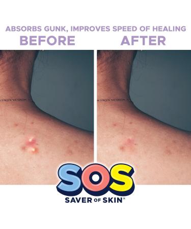 SOS SAVER OF SKIN - Hydrocolloid Acne Patches for Body Back Chest & More | 10 Count | Vegan & Latex Free - Buy Online on GoSupps.com