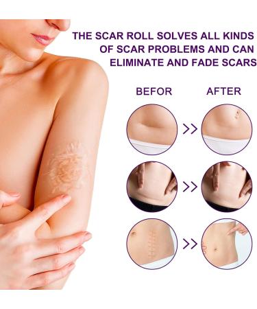 Medical Grade Silicone Scar Sheets & Tape Roll - Keloid Treatment C-Section & Old Scars - Reusable Strong Adhesion Waterproof 1.6in x 135in - Buy Online on GoSupps.com