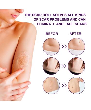 Medical Silicone Scar Tape Roll - 1.6 x 135 inch - Professional Nursing Stickers for C-Section, Keloid, Burn, Surgical Scars - Hypoallergenic Scar Away Sheets - Buy Online on GoSupps.com