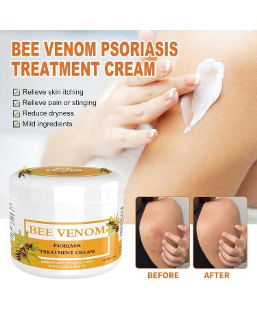 Bee Venom Psoriasis Cream - Bee Venom Psoriasis Cream New Zealand Bee Venom Cream Fast-Acting Relief Bee Venom Cream Psoriasis Cream Soothing Psoriasis Cream - Buy Online on GoSupps.com
