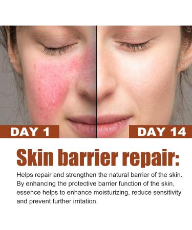 Rosacea Face Serum Face Serum Hyaluronic Acid Face Oil Anti-Aging Relieve Redness &Quick Repair Damage Skin Niacinamide Serum Replumps & Hydrates Collagen Face Serum-Protect Skin+Reduce Acne-Women 1 - Buy Online on GoSupps.com