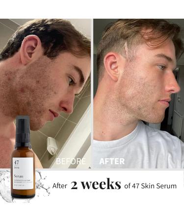 47 Skin Silver Chitoderm Anti Blemish Scar Repair Serum 100ml - Hydrating Face Serum for Acne and Scars - Mandarin Scent - Buy Online on GoSupps.com