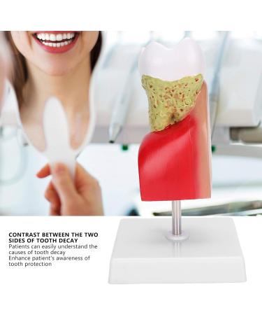 Verdant Touch Tooth Model - Dental Caries Teaching & Training Aid for Patient Education - International Shipping - Buy Online on GoSupps.com