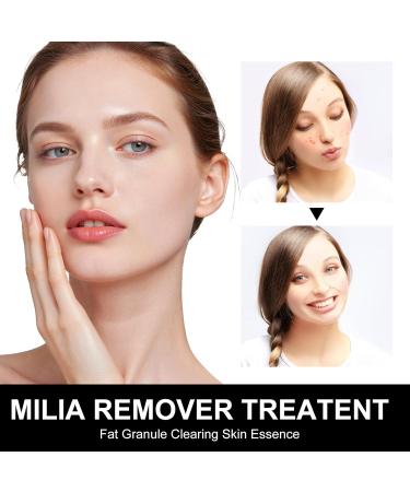 Milia Remover Treatment Serum Spot Treatment for Clear Skin Acne Serum for Eye & Face Easy to carry (1 count pack of 30ml) (black) - Buy Online on GoSupps.com