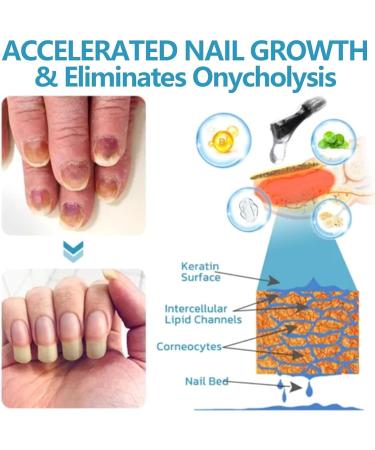 2PCS OnycholysisHeal Nail Strengthening And Growth Conditioner Nail Strengthener for Damaged Nails - Buy Online on GoSupps.com