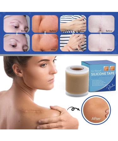 Retailio Silicone Scar Sheets - Soften, Flatten Scars, C-Section, Keloid Surgery - Reusable, Washable - 1.6x60 - Buy Online on GoSupps.com