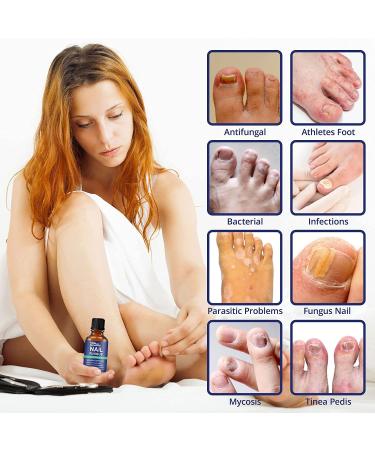 Potent Nail Fungus Treatment for Toenail Revitalization | Antifungal Solution for Stubborn Toenail Fungus | Enhances Nail Health & Repairs Damaged Nails - Buy Online on GoSupps.com