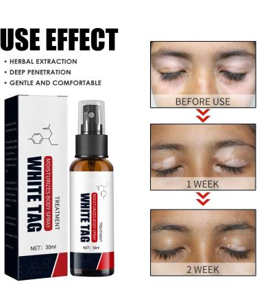 Skin Vitiligo Care Spray - Easy to Use Whitening Formula for Deficient Skin Pigment Repair - Buy Online on GoSupps.com