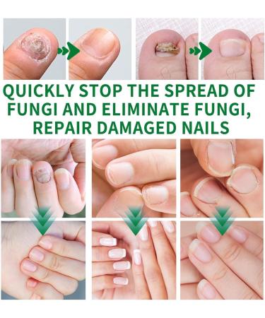 Nail fungus treatment gel nail fungus treatment cream for repair and strengthening natural and gentle advanced formula safe and effective1pc - Buy Online on GoSupps.com