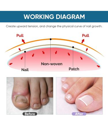 Ingrown Toenail Treatment: Professional, Safe, and Painless Corrector Strips - 50Pcs - Buy Online on GoSupps.com