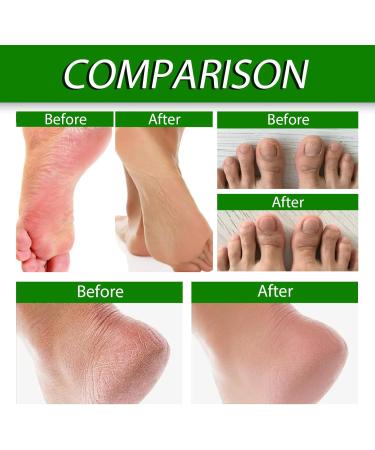 Urea Cream 40 Percent for Feet 40% Urea Cream for Cracked Heels and Dry Skin Aloe Vera Foot Cream with Tea Tree Oil Deep Moisturizing Callus Remover Nourishes Soften for Feet/Knees/Hands/Elbows - Buy Online on GoSupps.com