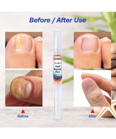 Treatonic Extra Strength Toe Nail Fungus Treatment - Fast Acting Cure for Toenail Fungus - 4 Count Pack - Buy Online on GoSupps.com