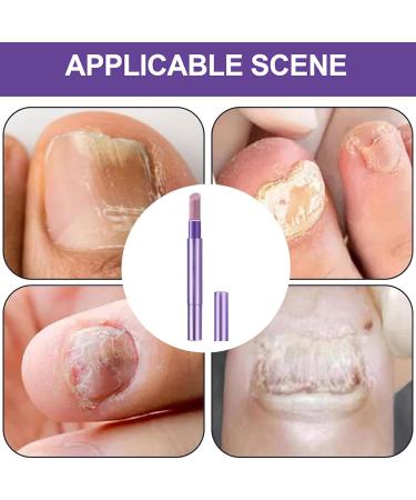 Nail strengthening Toenail Repair Pen Fast Acting Nail Care For Damaged Brittle Nails For Daily Use At Night Showering Manicure And Pedicure - Buy Online on GoSupps.com