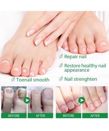 Nail Growth Serum with Ginger Extract - Repair & Strengthen Beautiful Nails | 30ml International Shipping - Buy Online on GoSupps.com