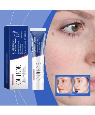 JOYVOIDX Herbal Acne Face Cream with Salicylic Acid Oil Balancing Formula for Gentle Pimple Care and Shine Control Moisturizing Skin Care 2.0 fl oz - Buy Online on GoSupps.com