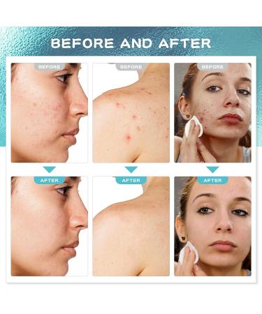 Paradise Emerald Cystic Acne Spot Treatment with Salicylic Acid and Tea Tree Oil - Hormonal Acne Solution for Face, Back, and Body - Pimple Cream for Teens & Adults - Buy Online on GoSupps.com