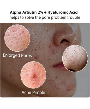 60ML Alpha Arbutin 2% + Hyaluronic Acid 2% Alpha Arbutin Serum Dark Spots Removal Hyaluronic Acid Serum Brightening Serum Hydrating Moisturiser Anti-Wrinkle Serum Anti Aging Serum - Buy Online on GoSupps.com