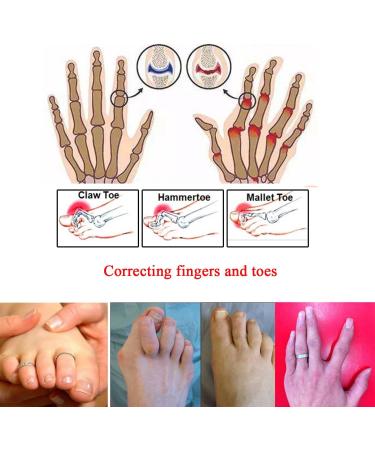 8 Pieces Non-Slip Toe Splint Wraps - Hammer Toe Straightener for Men & Women | Fix Broken Crooked and Overlapped Toes - Buy Online on GoSupps.com