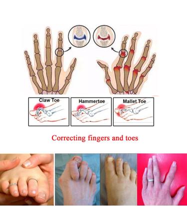 L Size 12 Pieces Toe Wraps & Splints Set for Broken and Hammer Toe Relief | Cushioned Bandages with Toe Separators for Corrective Support - Buy Online on GoSupps.com