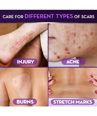 Cicatricure Advanced Scar Gel for Face & Body - Proven Results in 2 Weeks Scar Treatment for Surgical Scars Stretch Marks Scars of Burns and Injuries Acne Scar Treatment 2 oz (56g) - Buy Online on GoSupps.com