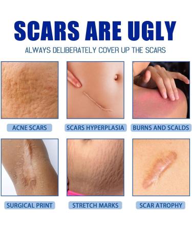 Scars Burns Cream - 30g Moisturizing Product for Scratching Marks - Reducing Cream for Old Scars - For Recovery of Cheloid Wounds Women Men Athletes - Buy Online on GoSupps.com