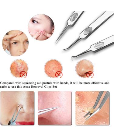 Benkeg Blackstroke Remover - 3-Piece Stainless Steel Acne & Blackhead Removal Tools | Facial Care Tweezers & Flaw Repair - Buy Online on GoSupps.com