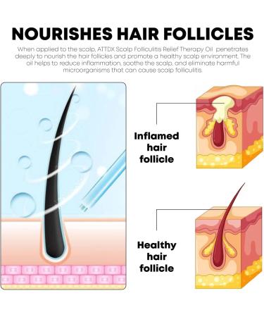 ATTDX Scalp Folliculitis Relief Oil GFOUK Scalp Folliculitis Treatment Oil Natural Remedies Nourishing Oil for All Hair Types - Buy Online on GoSupps.com