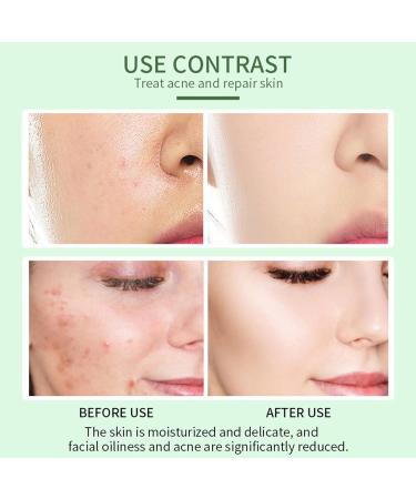 Azelaic Acid Balancing Serum Aloe Vera Moisturiser Face Serum Collagen Serum for Face Remove Blackhead Redness Relief and Acne Blemish Control Fade and Repair Dark Spots Skin Moisturizer - Buy Online on GoSupps.com