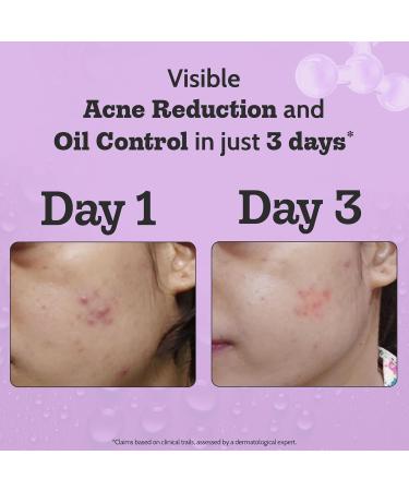 Chemist At Play 2% Salicylic Acid Face Serum | Treats Active Acne | Controls Excess Oil | Fades Acne Marks | Improves Skin Texture | 30ml Salicylic Acid 30ml - Buy Online on GoSupps.com