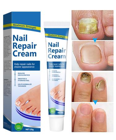 Fungal Nail Treatment Cream - Antifungal Cream Nail Fungus Treatment for Toenail Nail Repair Solution for Thick Cracked Discolored Nails