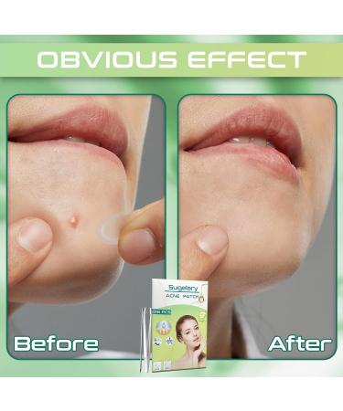 216PCs Hydrocolloid Pimple Patches - Invisible Waterproof Acne Treatment for Fast Healing | Two Sizes Available - Buy Online on GoSupps.com