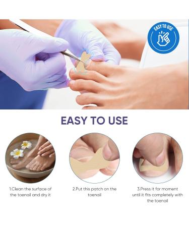 Ingrown Toenail Treatment: Professional, Safe, and Painless Corrector Strips - 50Pcs - Buy Online on GoSupps.com