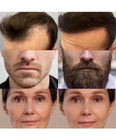 HAMINOS Derma roller 0.5mm with reservoir Micro needle roller for Hair Beard Skin and Lips Professional micro needles 140 titanium needles (Derma roller black 0.5mm) - Buy Online on GoSupps.com