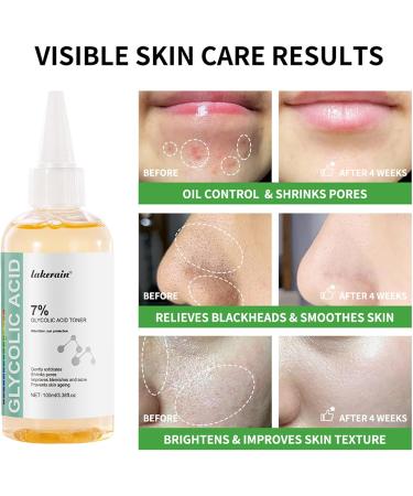 7% Glycolic Acid Toner Reduce Acnes Blemishes Pore Minimizer Gentle Exfoliating Face Toner Rejuvenate Moisturize Skin Improves Skin Brightness Suitable for Normal/Oily Skin - Buy Online on GoSupps.com