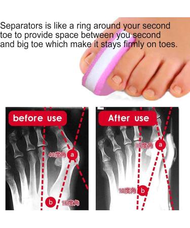 20 Pieces Foam Toe Separator - Relieve Pain Prevent Friction Improve Comfort for Overlapping Toes - Buy Online on GoSupps.com
