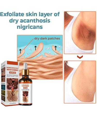 KOAHDE Hand Knuckle Whitening Serums Knuckle Skin Lightening Serums Dark Knuckle Whitening Serums Dark Knuckle Corrector Serums Removing Dark Spots Essence Acanthosis Nigricans Whitening Oil 50ML - Buy Online on GoSupps.com