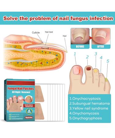 Toe Nail Patches for Fungus - Fast & Effective Nighttime Renewal | 16 Safe Fungal Nail Patches for Ultimate Foot Care - Buy Online on GoSupps.com